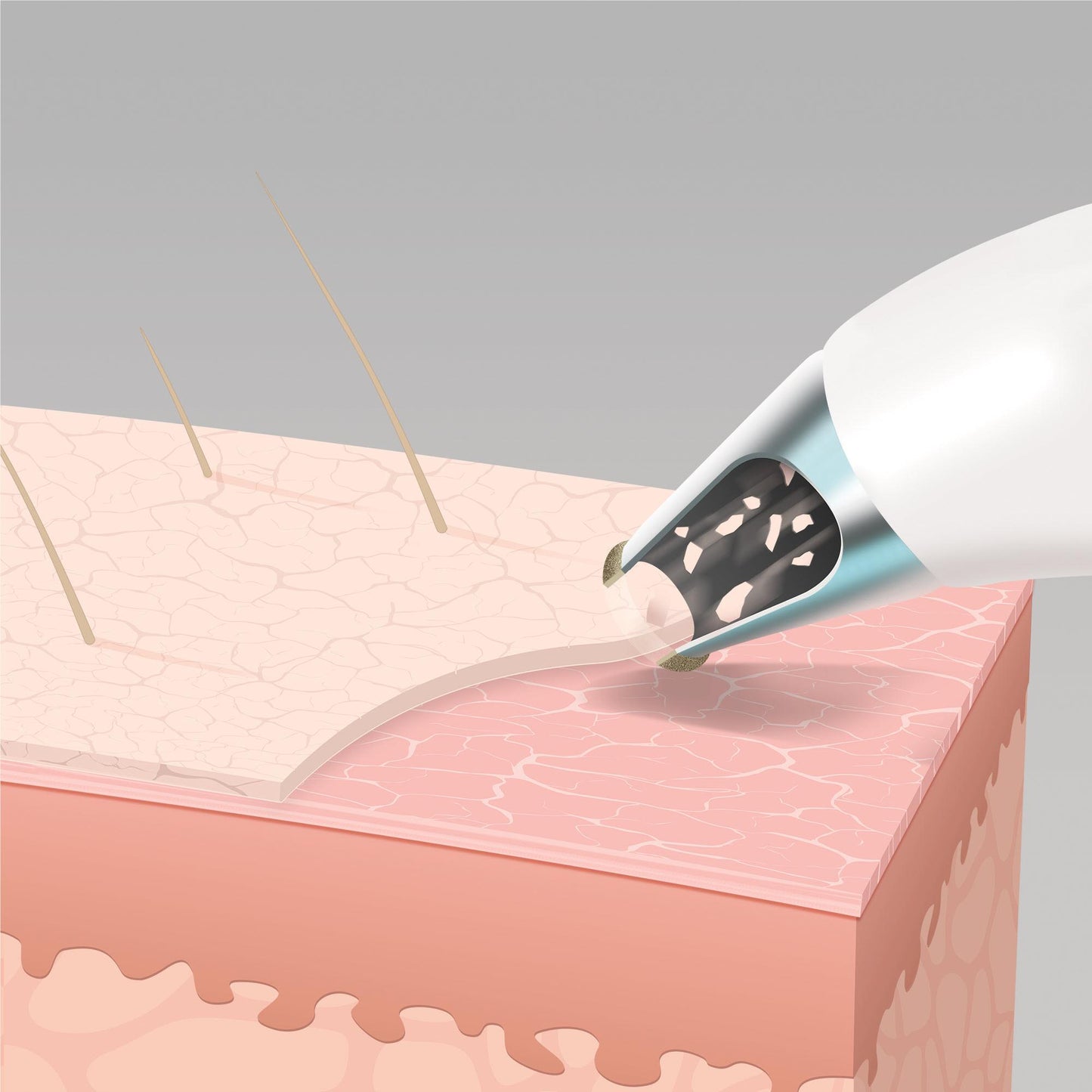Homedics Radiance Microdermabrasion