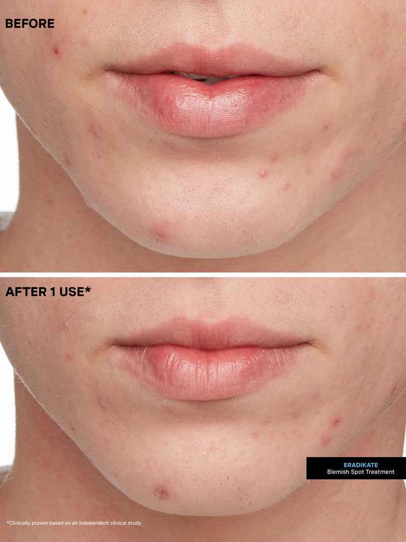 EradiKate Acne Treatment