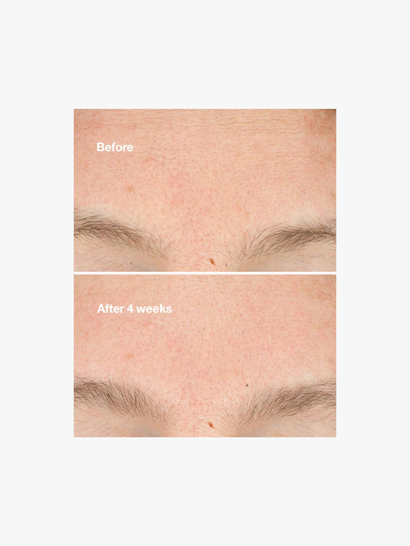 Clarifying Micro Peel