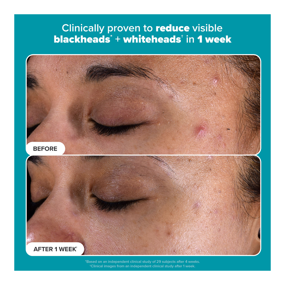 2% BHA Liquid Exfoliant Travel Size - 30ml