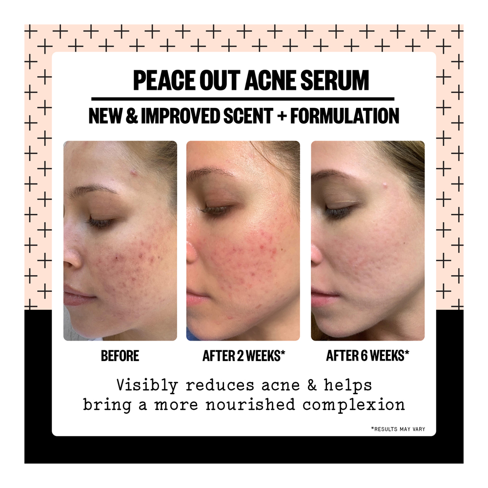 Acne Serum - 30ml