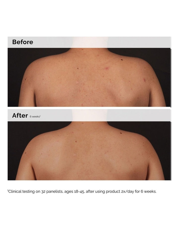 Salicylic Acid 0.5% Body Serum Exfoliating Solution for Blemish-Prone Skin 240ml
