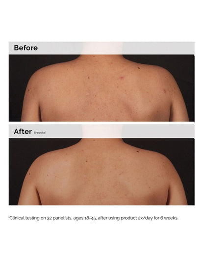 Salicylic Acid 0.5% Body Serum Exfoliating Solution for Blemish-Prone Skin 240ml