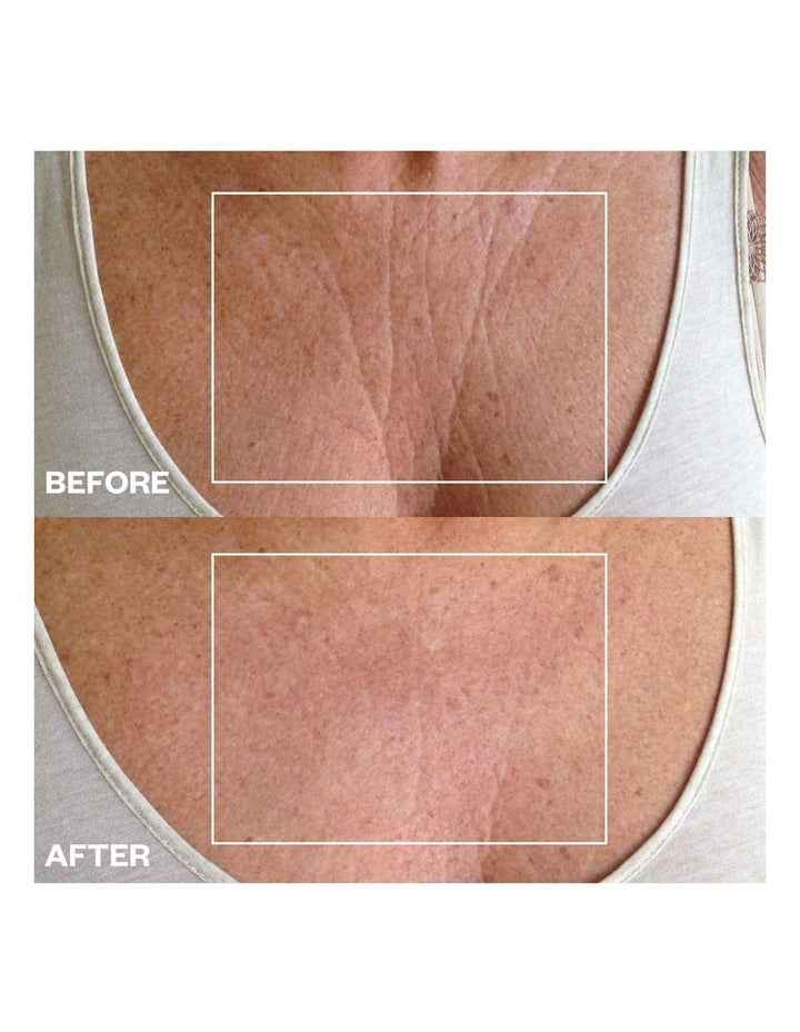 Chest Wrinkle Patch - 1 Patch