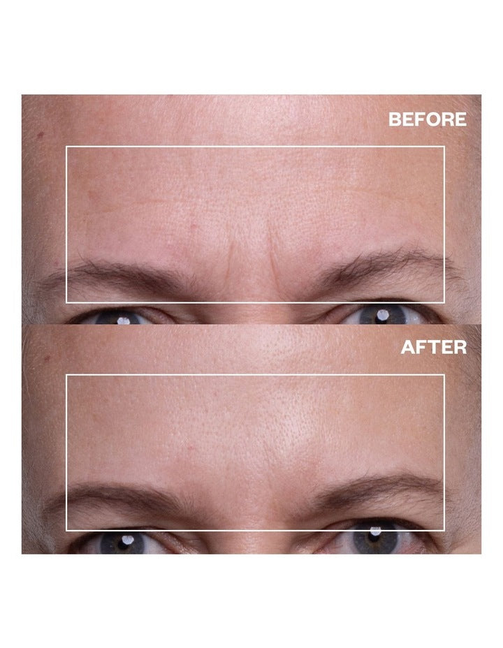 Forehead Wrinkle Patch - 2 Patches