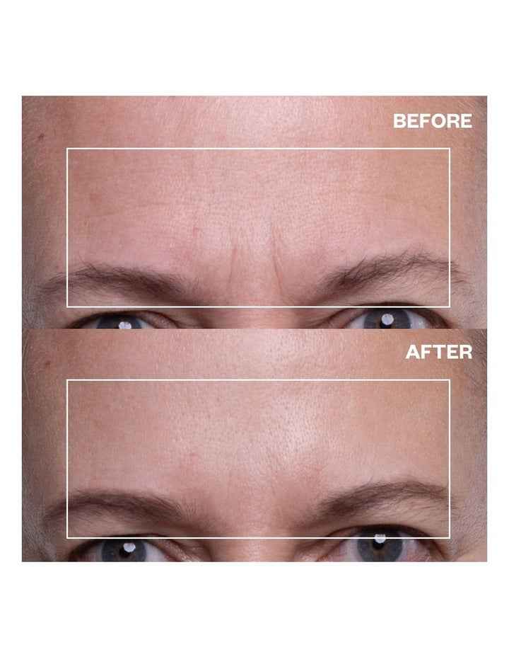 Forehead Wrinkle Patch - 2 Patches