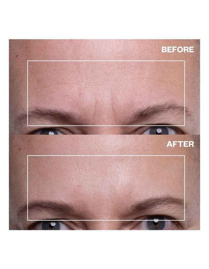 Forehead Wrinkle Patch - 2 Patches