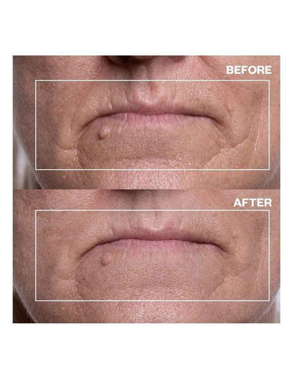 Mouth & Lip Wrinkle Patches - 2 Patches