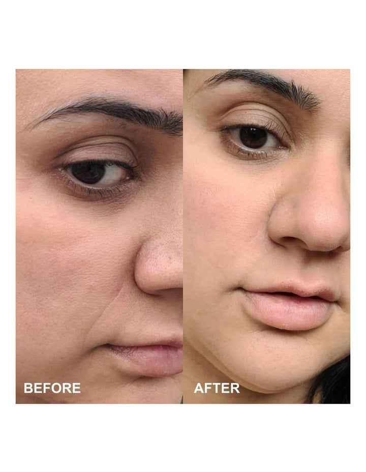 Self-Dissolving Microneedle Patches - 8 Patches