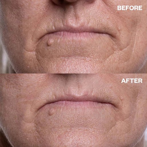 Wrinkles Schminkles Mouth & Lip Wrinkle Patches 2 Patches - GimmeNow