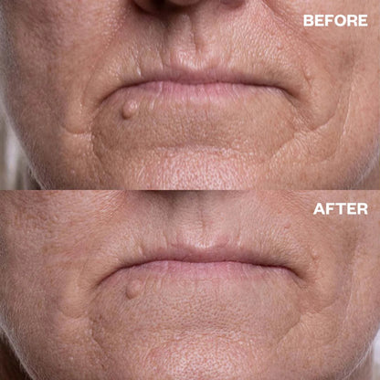 Wrinkles Schminkles Mouth & Lip Wrinkle Patches 2 Patches - GimmeNow