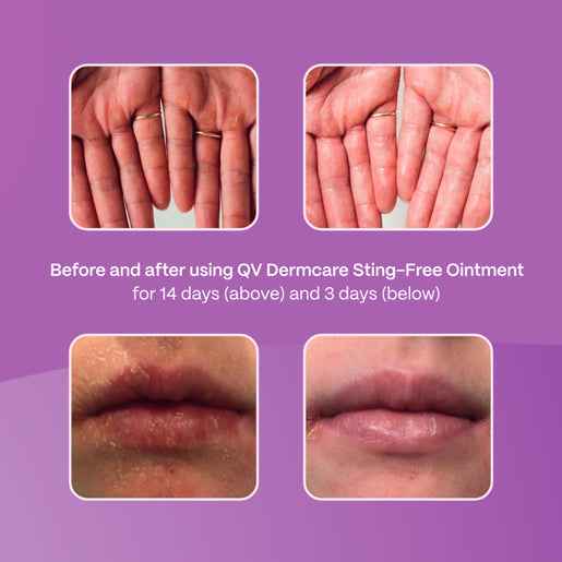 Ego QV Dermcare Sting-Free Ointment 200g