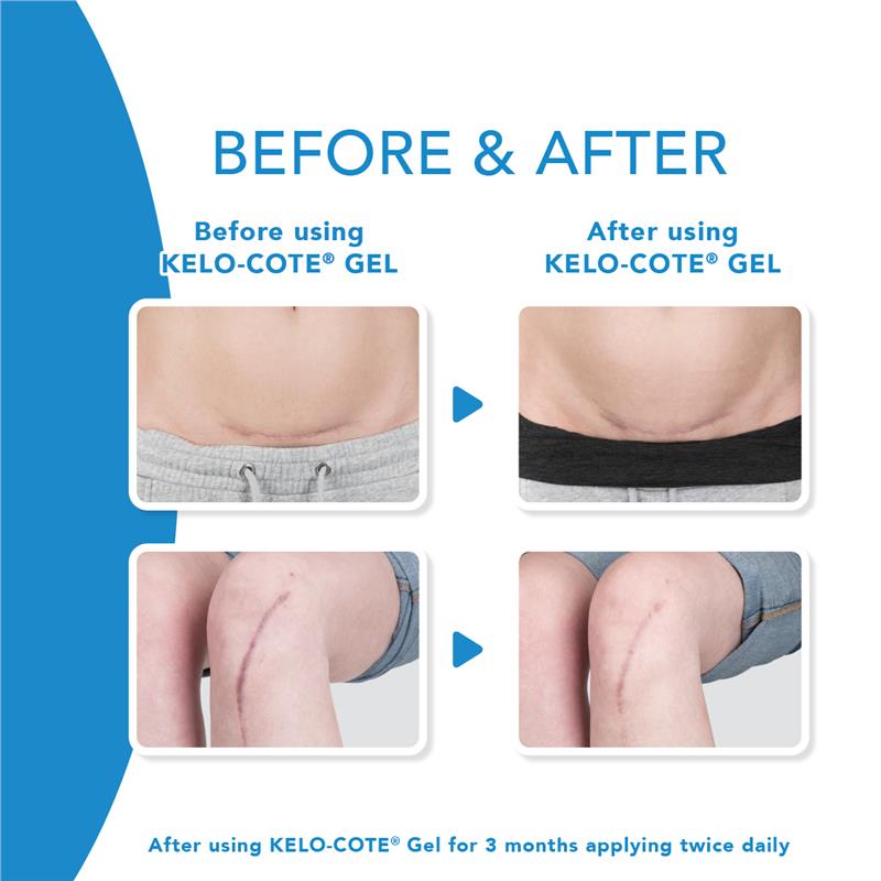 Kelo-Cote Scar Treatment Gel 15g