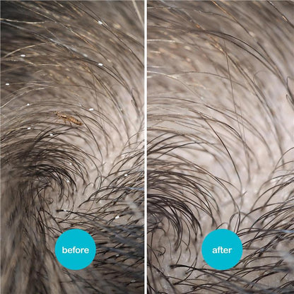 Nitwits Head Lice Comb Twin Pack