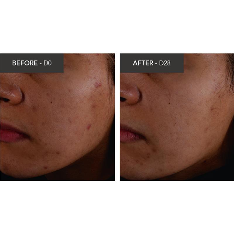 Bioderma Sebium Kerato Nonirritating Acne Cream Moisturiser suitable For Acne Prone Skin 30ml