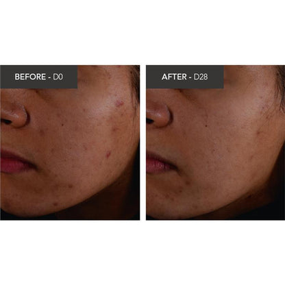 Bioderma Sebium Kerato Nonirritating Acne Cream Moisturiser suitable For Acne Prone Skin 30ml