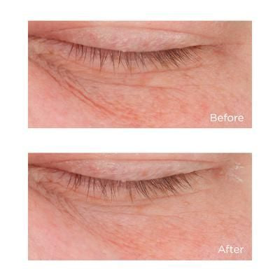 Cold Plasma Plus+ Eye