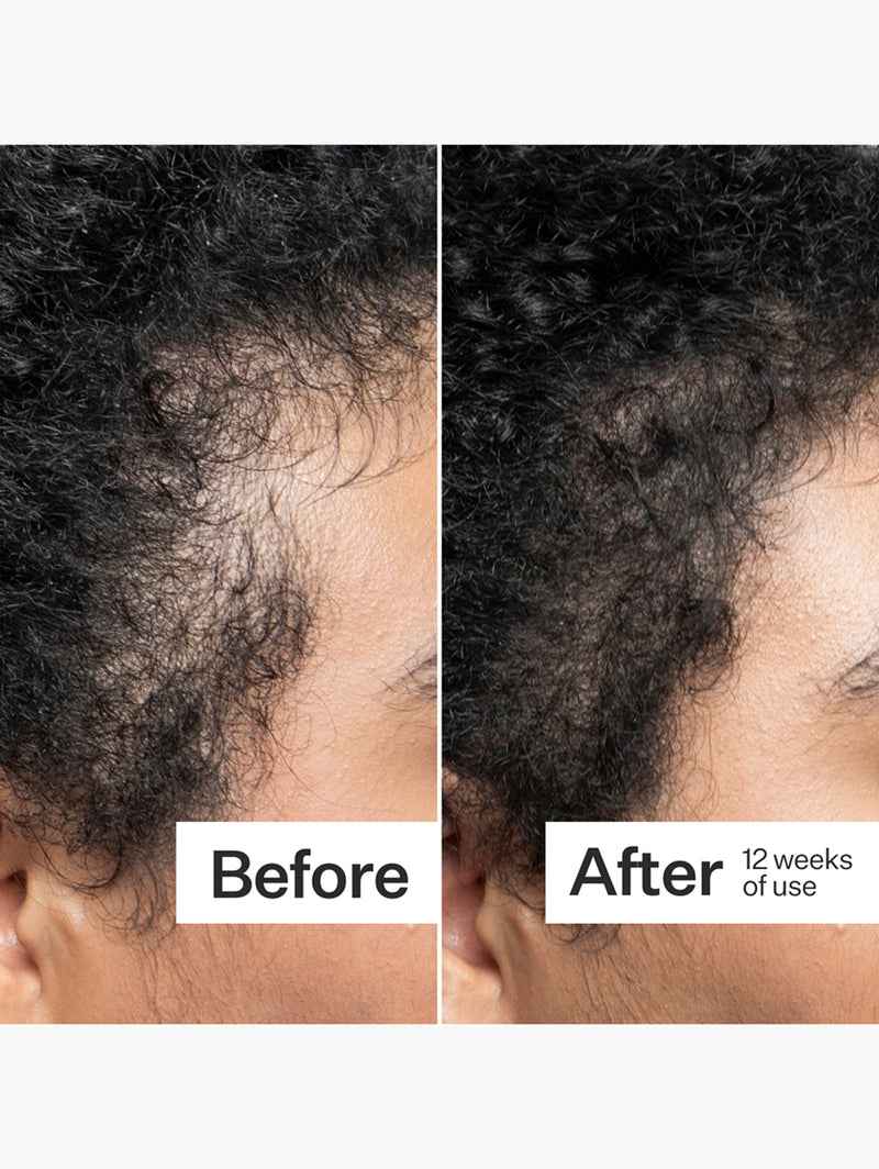 Scalp Dermastamp For Thicker + Fuller Looking Hair