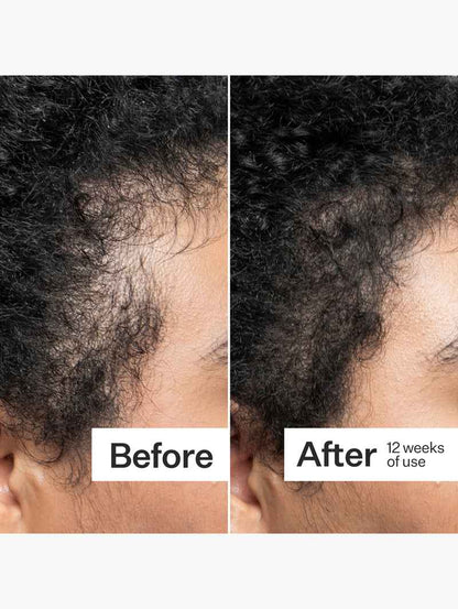 Scalp Dermastamp For Thicker + Fuller Looking Hair