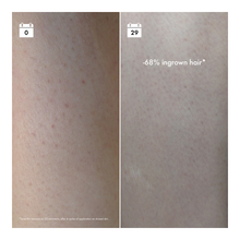 Ingrown Hair Pads