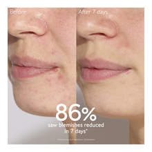 New Vinopure Blemish Control Salicylic Serum - 30ml