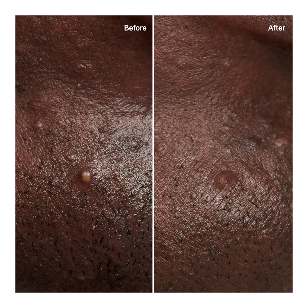 Hydrocolloid Invisible Pimple Patches - 14g