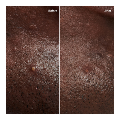 Hydrocolloid Invisible Pimple Patches - 14g