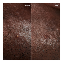 Hydrocolloid Invisible Pimple Patches - 14g