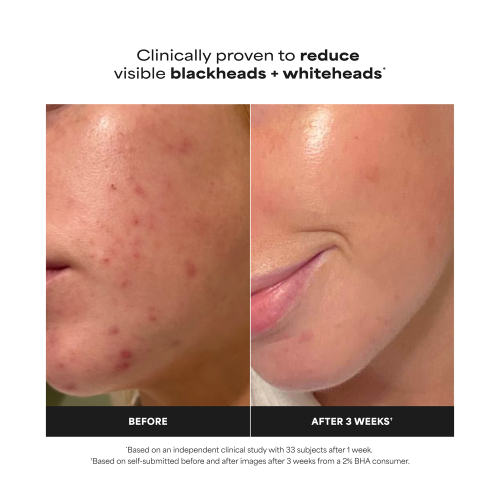 Skin Perfecting 2% BHA Liquid Exfoliant - 118ml