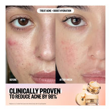 Acne Moisturizer - 50ml