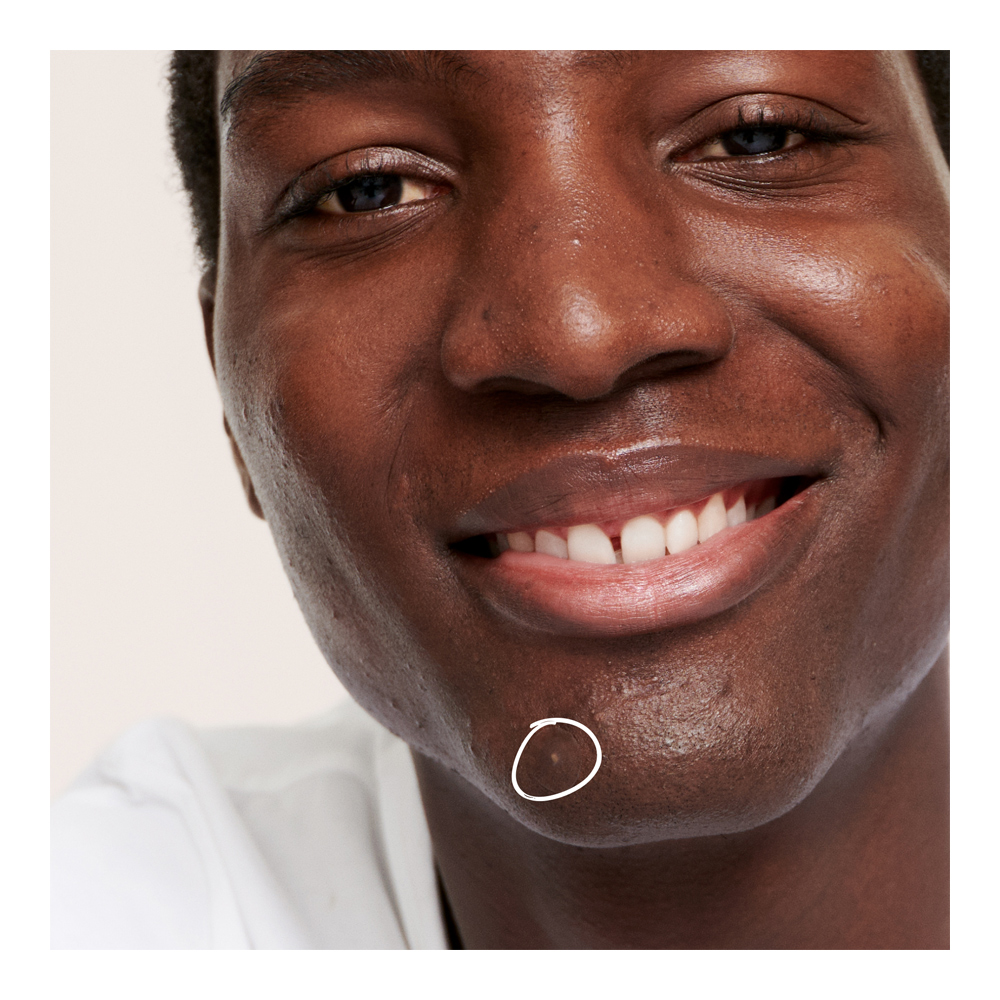 Hydrocolloid Invisible Pimple Patches - 14g