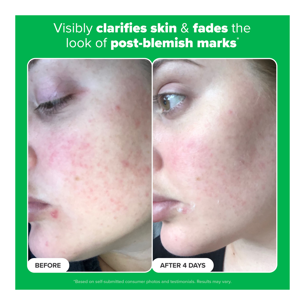 10% Azelaic Acid Booster - 30ml