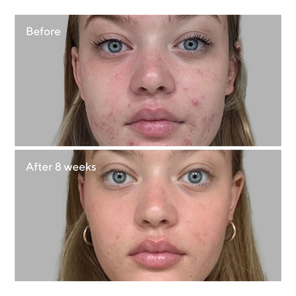 Blemish Control Biome-Balancing Clear & Prevent Blemish Treatment Serum - 30ml