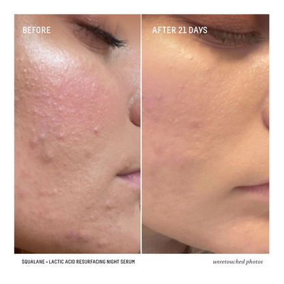 Squalane + 10% Lactic Acid Resurfacing Serum - 30ml