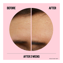 Wrinkles Microneedling Patches - 6 Pieces