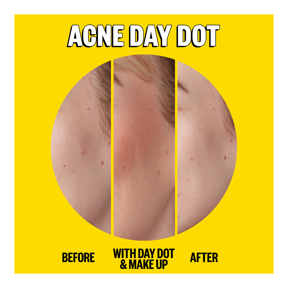 Acne Day & Night Duo