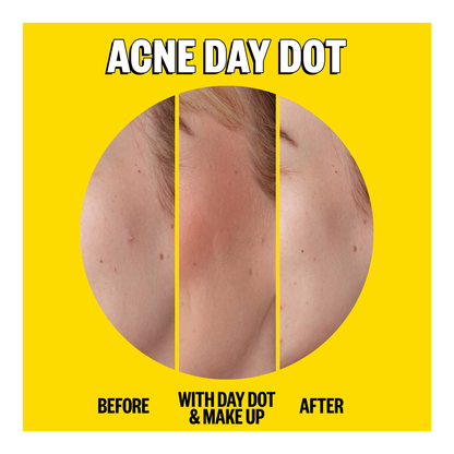 Acne Day & Night Duo