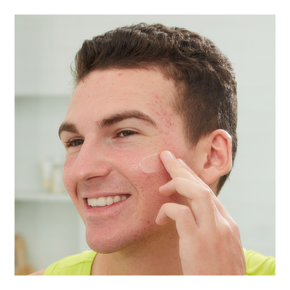 Acne Serum - 30ml
